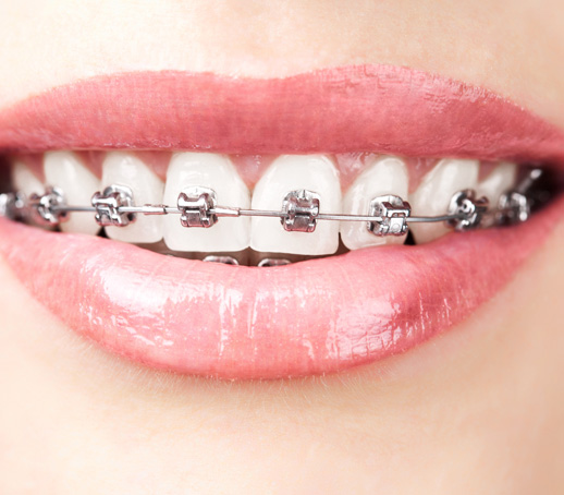 Metal braces