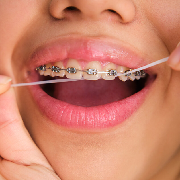 Food caught between your teeth