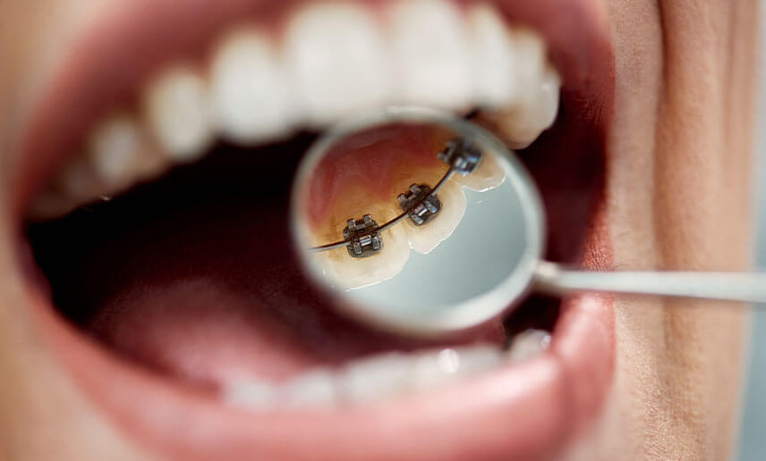 The pros and cons of lingual braces The pros and cons of lingual braces
