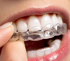 Getting started with Invisalign®