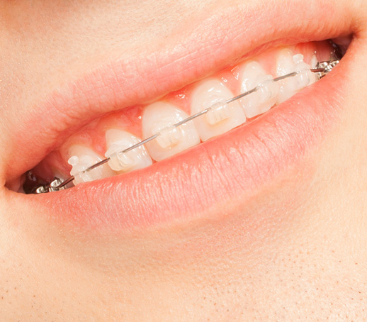 Clear Braces, Ceramic Braces Canberra