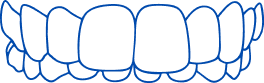 Overbite (overjet)
