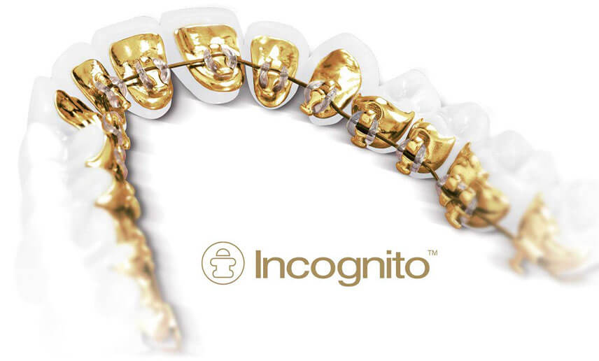 Lingual Braces
