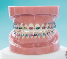 Choose your braces colours