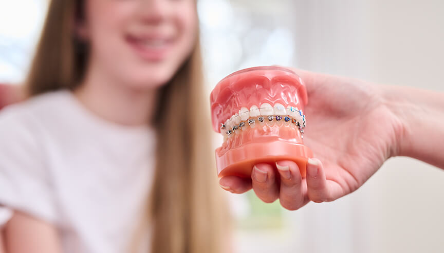 Getting started with braces 