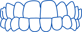 Overbite